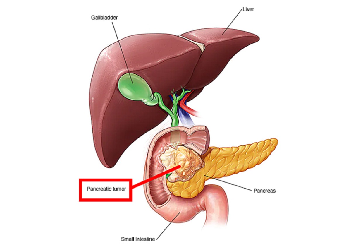 췌장암 위치 (출처 : MAYO Clinic.org)